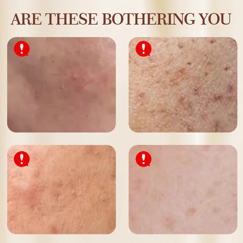 Crema calmante multifuncional para el tratamiento del acné-ES