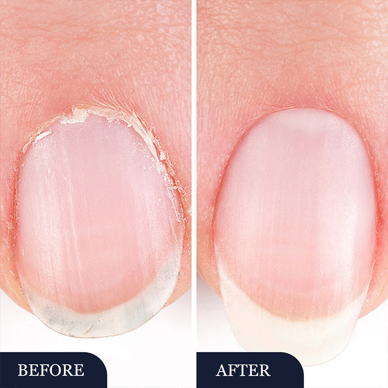 🔥Svinčnik za zdravljenje glivic na nohtih (za poškodovane nohte)-SI